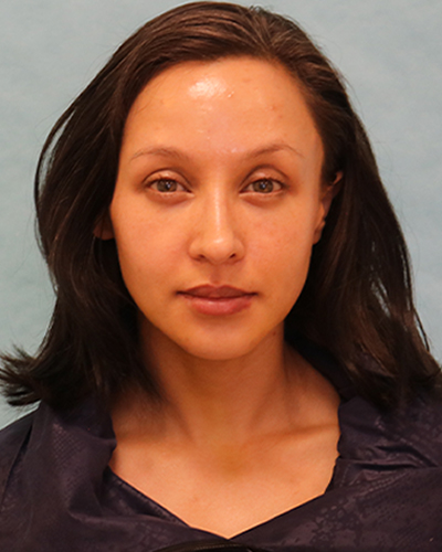 Chin Augmentation Patient
