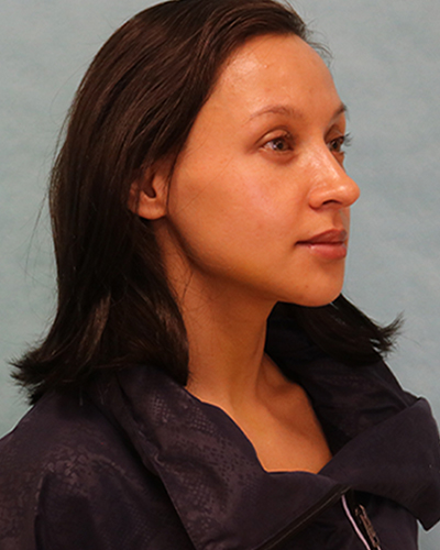 Chin Augmentation Patient