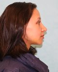 Breast Lift Patient
