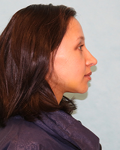 Breast Lift Patient
