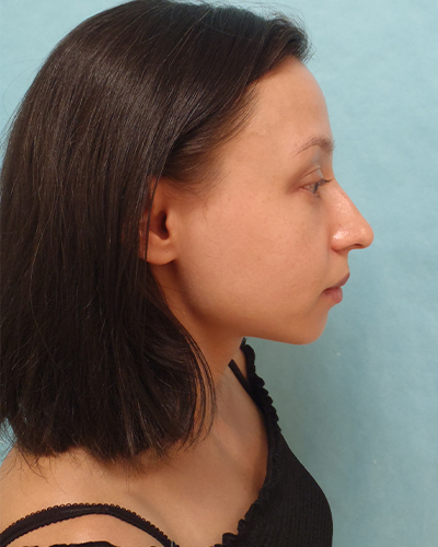 Chin Augmentation Patient