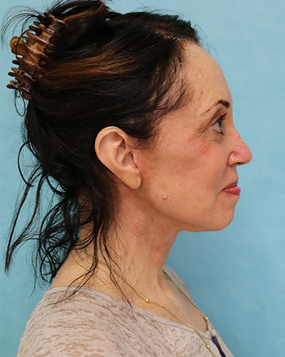 facelift patient