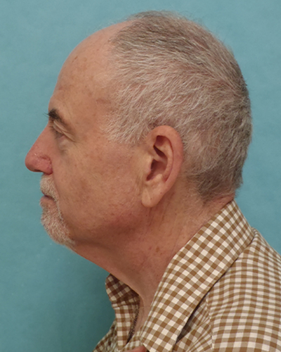 facelift patient