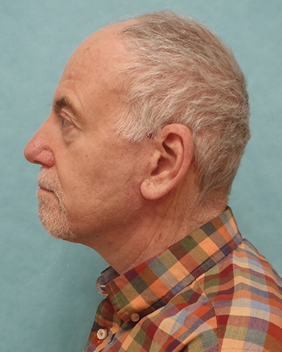 facelift patient
