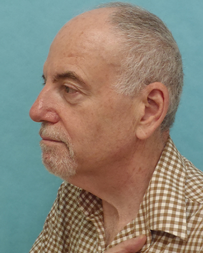 facelift patient