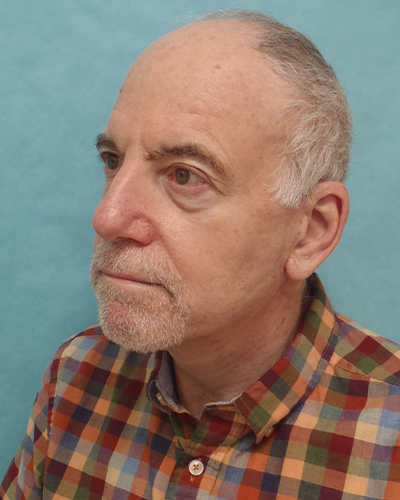 facelift patient