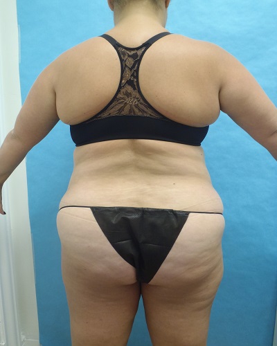Liposuction Patient