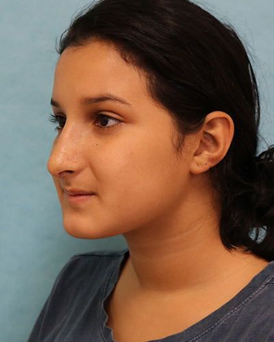 Rhinoplasty Patient