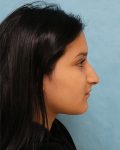 Breast Lift Patient
