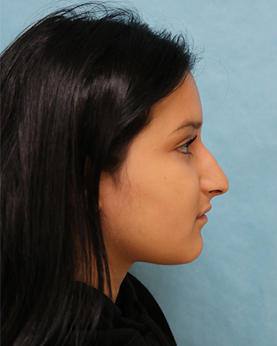 Breast Lift Patient