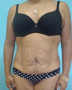 tummy tuck patient